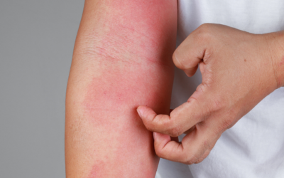 Eczema: What You Need To Know