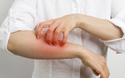 It’s Not Allergies – It’s Histamine Intolerance! Here’s What to Know